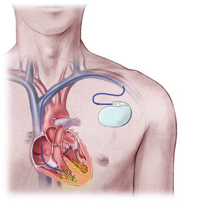 Indosso Vestiti Approvazione Stevenson Defibrillatore Cuore A Cosa